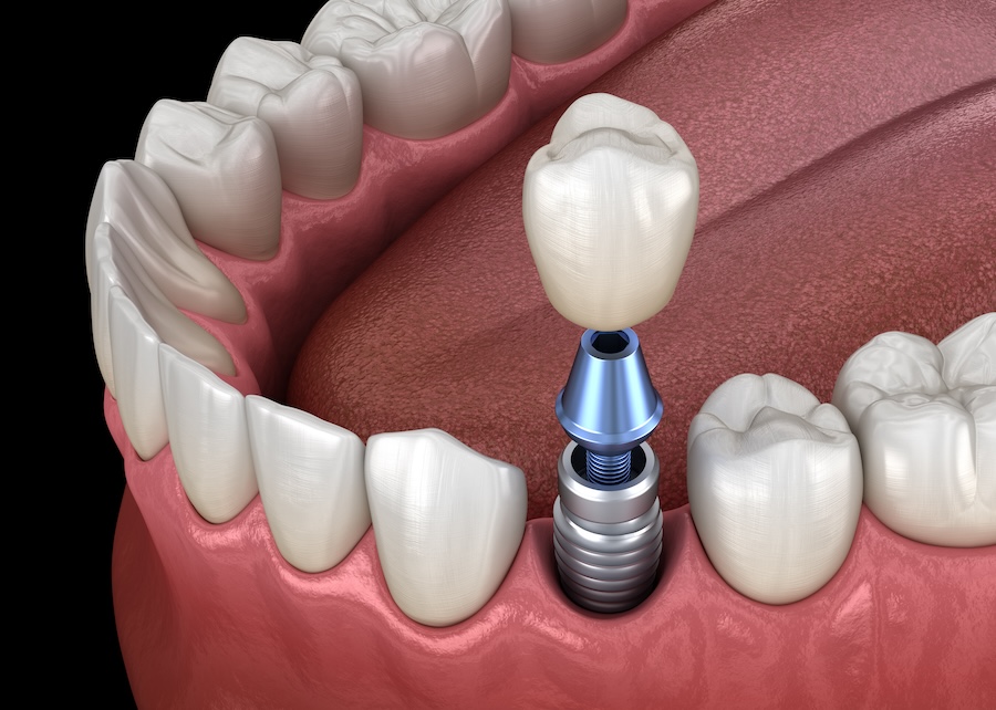 Dental Implant Fixing