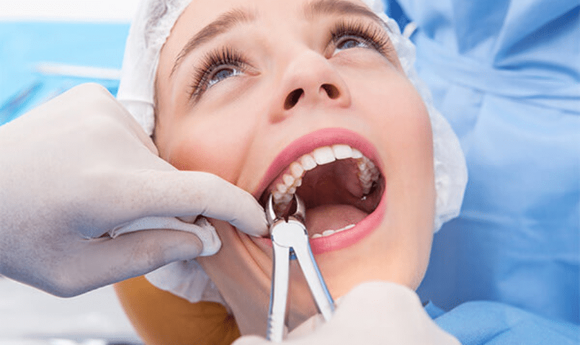 Tooth Extraction